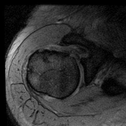 Subcoracoid Impingement Radiology Reference Article Radiopaedia Org