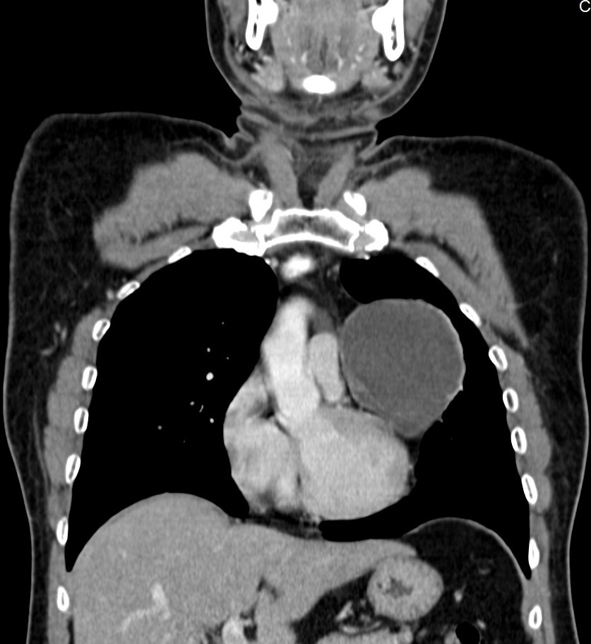 Pericardial Cyst Image Radiopaedia Org