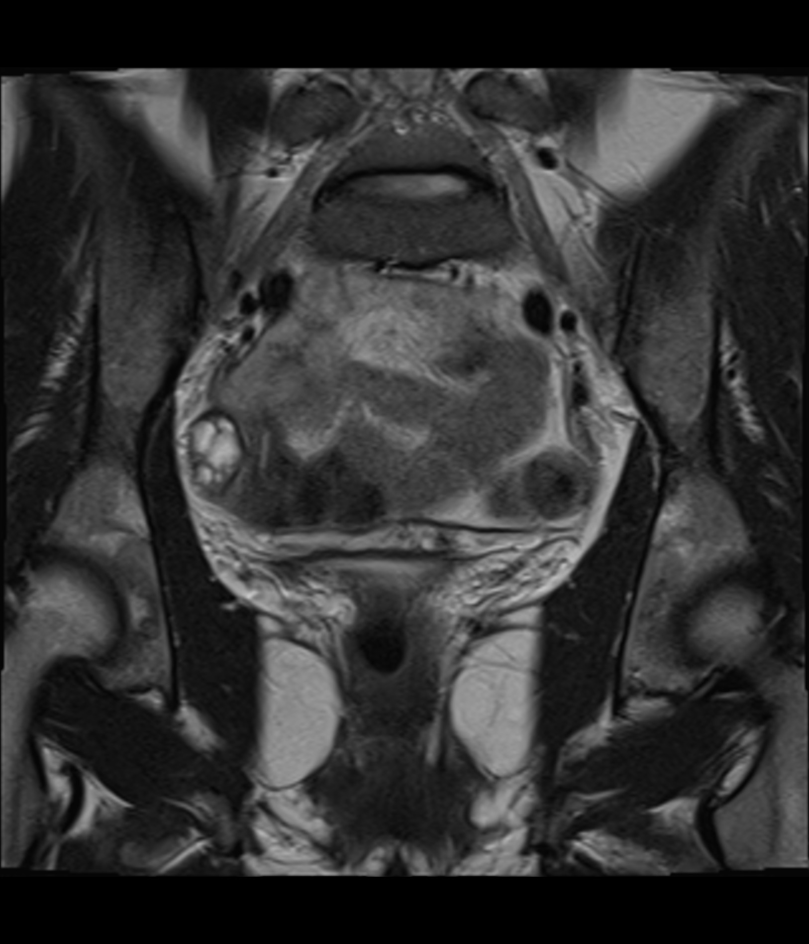 Mayer Rokitansky K Ster Hauser Syndrome Image Radiopaedia Org