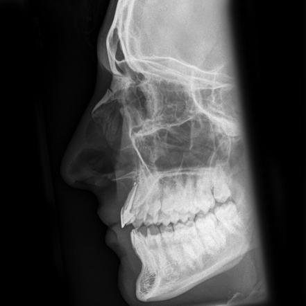 Nasal Bone Fracture Radiology Case Radiopaedia Org