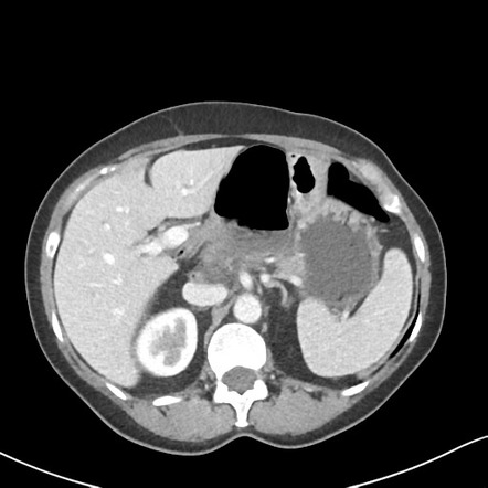 Lesser Sac Hernia Radiology Reference Article Radiopaedia Org