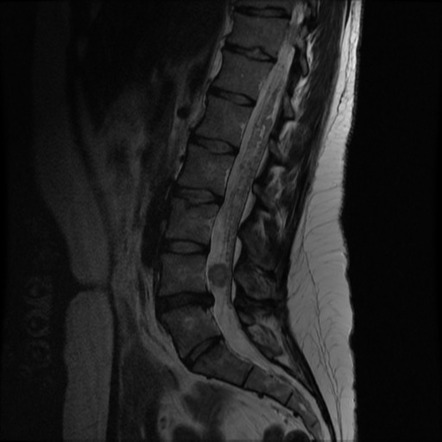 Multiple Cauda Equina Schwannomas In Neurofibromatosis Type Image