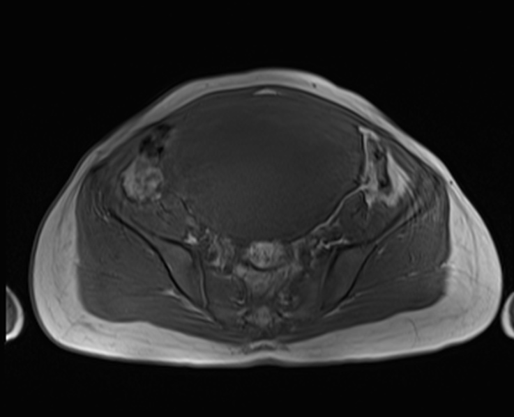 Diffuse Uterine Adenomyosis Image Radiopaedia Org