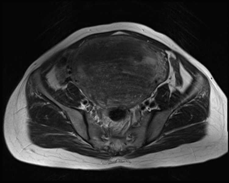 Diffuse Uterine Adenomyosis Image Radiopaedia Org