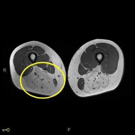 Limb Girdle Muscular Dystrophy Type 2A Radiology Case Radiopaedia Org