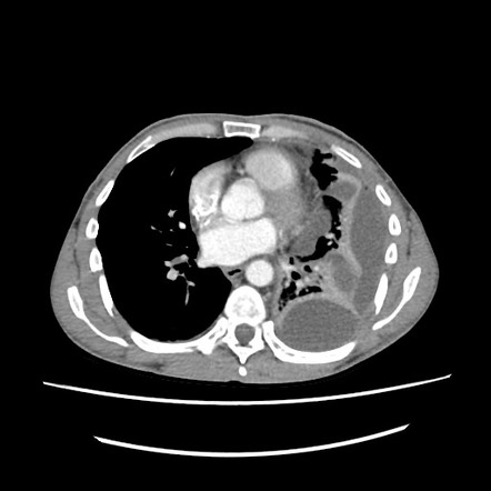 Pleural Empyema Radiology Reference Article Radiopaedia Org