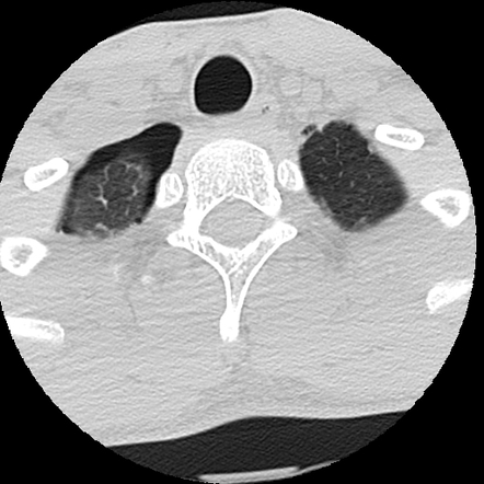 Apical Pneumothorax On Cervical Spine Ct Radiology Case Radiopaedia Org