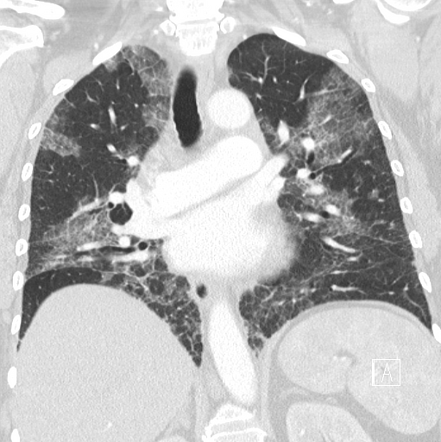 Pulmonary Embolism Radiology Reference Article Radiopaedia Org