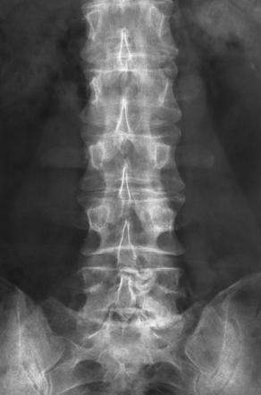 Lumbar Ependymoma Radiology Case Radiopaedia Org