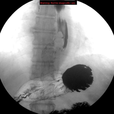 Esophageal Cancer Radiology Case Radiopaedia Org