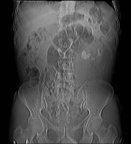 Renal Replacement Lipomatosis Image Radiopaedia Org