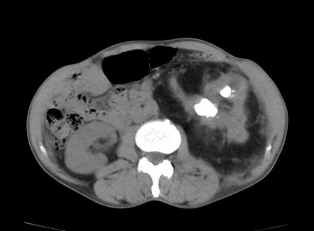 Renal Replacement Lipomatosis Radiology Case Radiopaedia Org