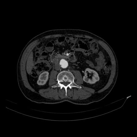 Saccular Aortic Aneurysm Image Radiopaedia Org