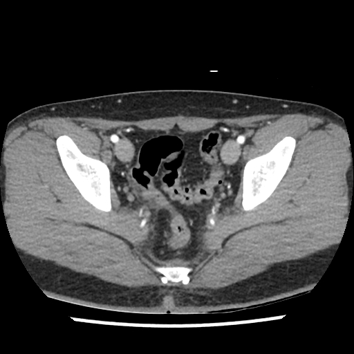 Subtle Sacral Fracture With Trace Pre Sacral Hemorrhage Image