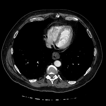 Adenocarcinoma Of The Esophagus Radiology Case Radiopaedia Org