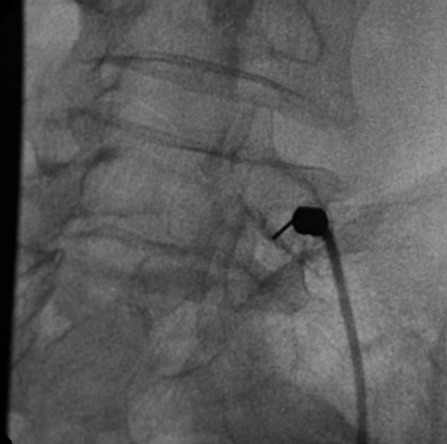 L5 Nerve Root Block Fluoroscopic Image Radiopaedia Org