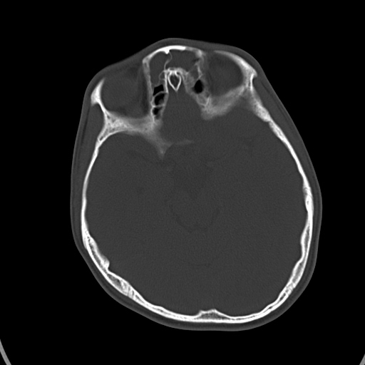 Osteoma Skull Vault Image Radiopaedia Org