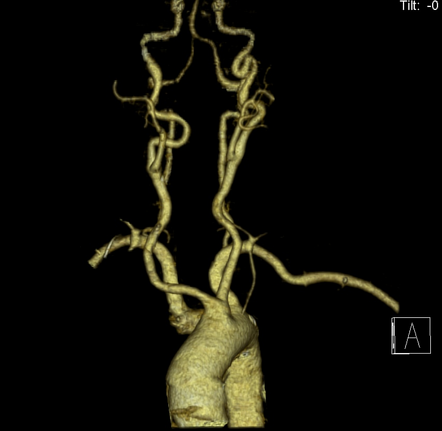 Aberrant Right Subclavian Artery Radiology Case Radiopaedia Org