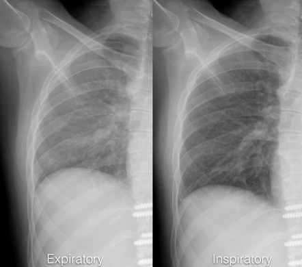 Chest Expiratory View Radiology Reference Article Radiopaedia Org