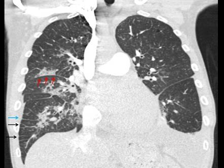 Unilateral Pulmonary Edema Radiology Reference Article Radiopaedia Org