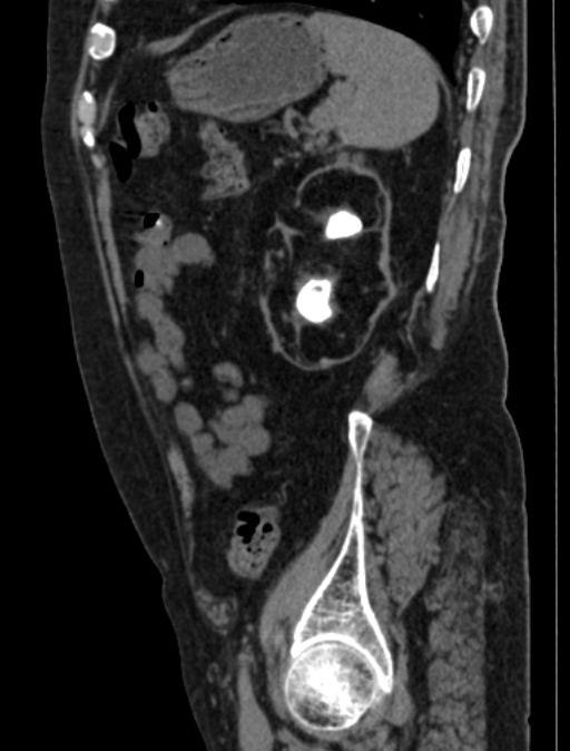 Renal Replacement Lipomatosis Image Radiopaedia Org