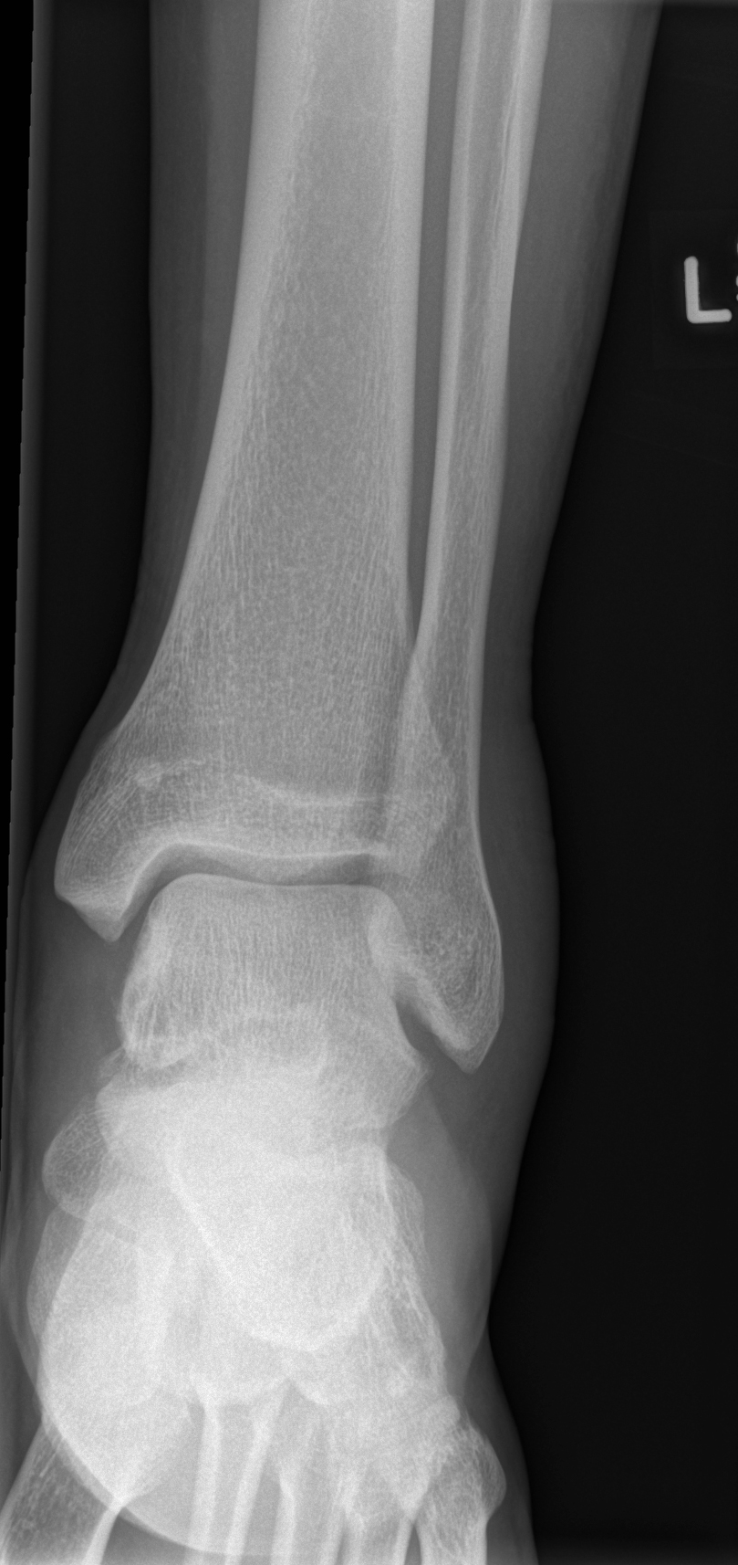 Posteromedial Tubercle Fracture Of The Talus Image Radiopaedia Org