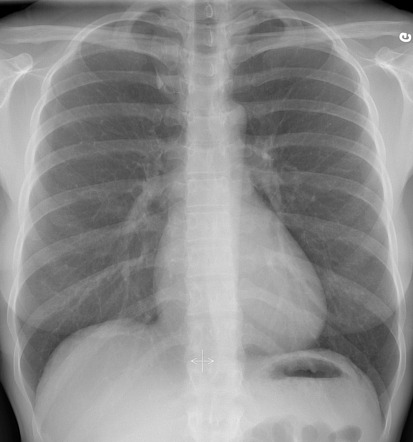 Radiology Quiz Radiopaedia Org Playlist Chest X Ray Basic