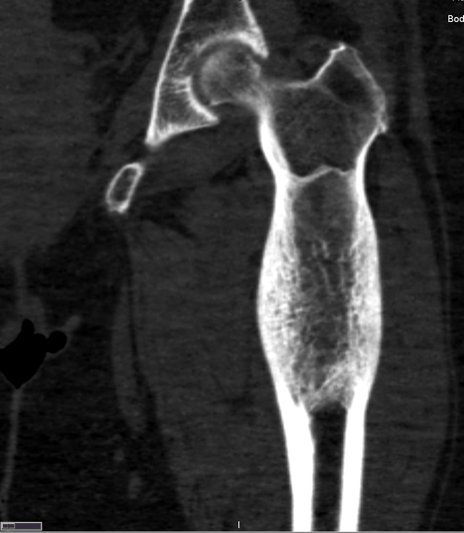 Intraosseous Hemangioma Of The Femur Image Radiopaedia Org