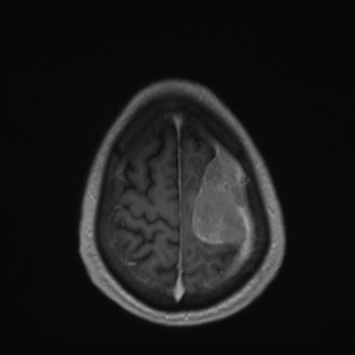 Rhabdoid Meningioma Image Radiopaedia Org