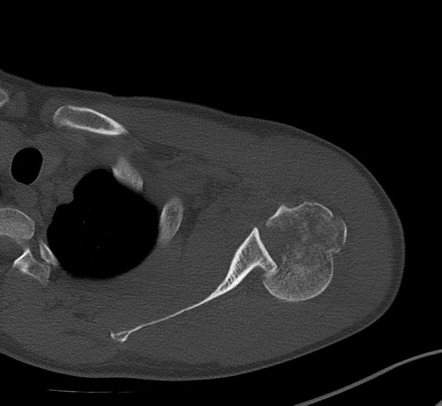 Posterior Shoulder Fracture Dislocation Radiology Case Radiopaedia Org