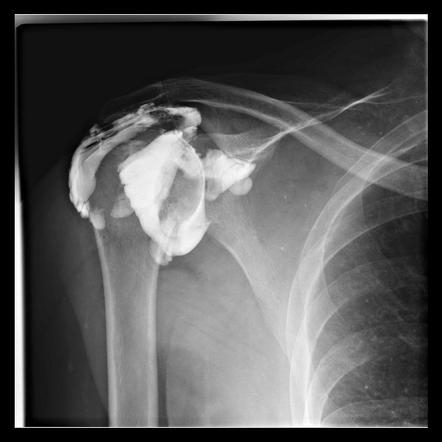 Rotator Cuff Tear Radiology