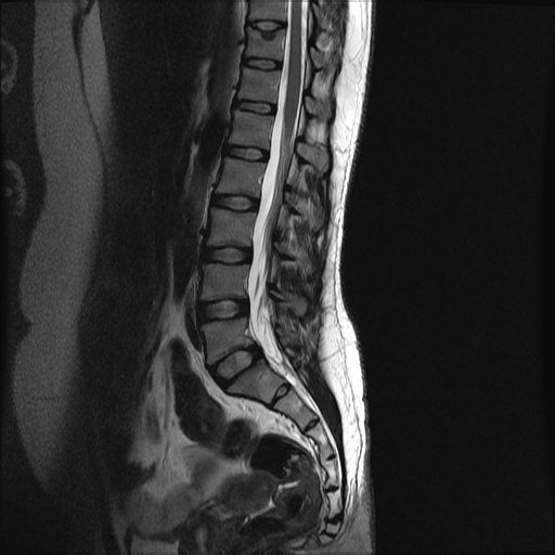 Spinal Meningeal Cyst Perineural Cyst Image Radiopaedia Org