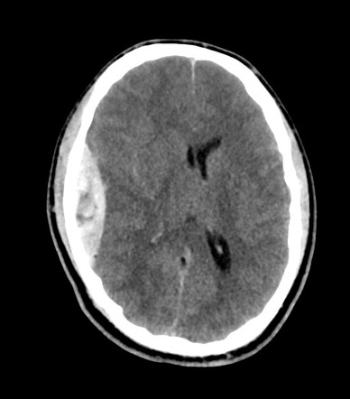 Extradural Haematoma Swirl Sign Radiology Case Radiopaedia Org