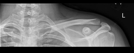 Normal Clavicle Radiograph Radiology Case Radiopaedia Org