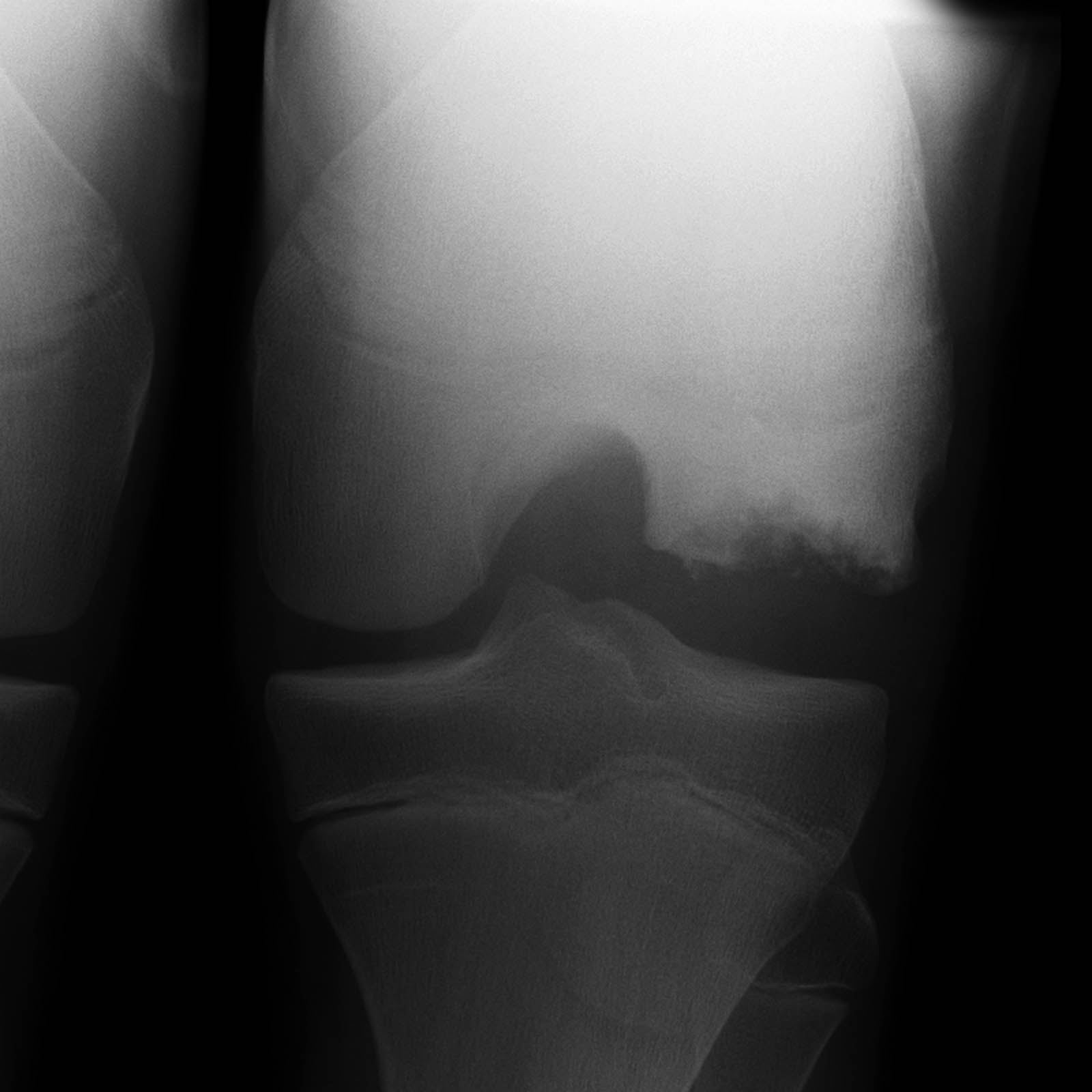 Osteochondritis Dissecans Image Radiopaedia Org