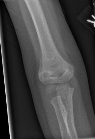 Supracondylar Fracture Radiology Case Radiopaedia Org