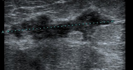 Breast Abscess Radiology Reference Article Radiopaedia Org