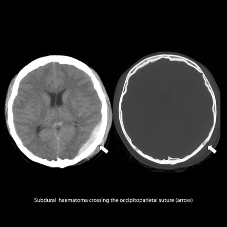 Extradural Haematoma Vs Subdural Haematoma Radiology Reference