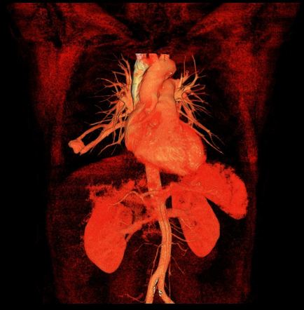 Pulmonary Arteriovenous Malformation Radiology Reference Article