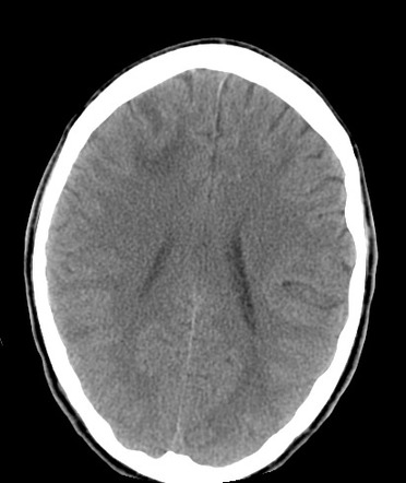 Central Nervous System Vasculitis Radiology Case Radiopaedia Org