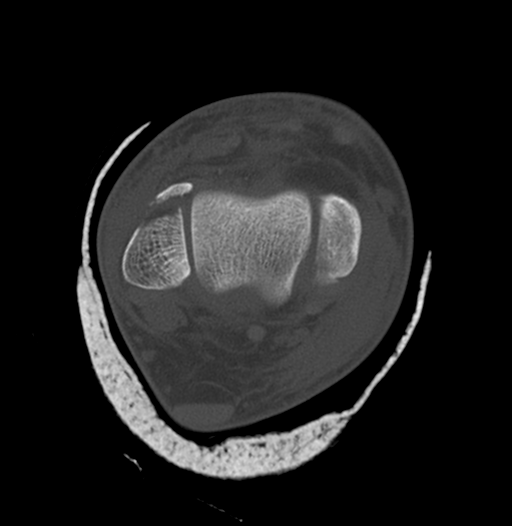 Trimalleolar Ankle Fracture Image Radiopaedia Org