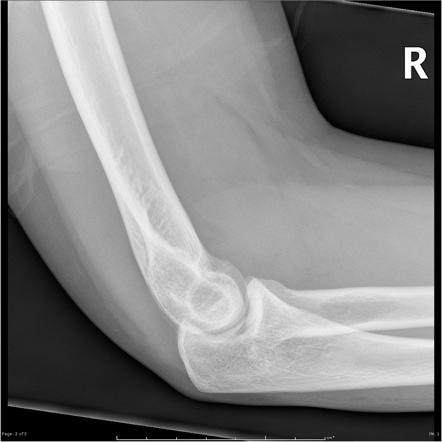 Radial Head Fracture Image Radiopaedia Org