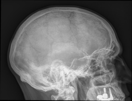 Enlarged Sella Turcica Differential Radiology Reference Article Radiopaedia Org