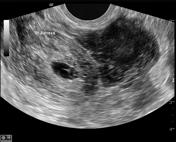 Tubal Ectopic Pregnancy Radiology Reference Article Radiopaedia Org