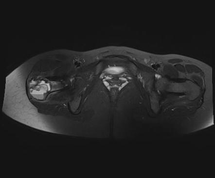 Aneurysmal Bone Cyst Radiology Reference Article Radiopaedia Org