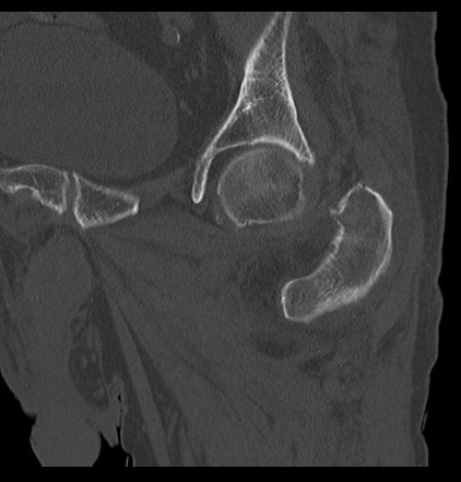 Greater Trochanteric And Incomplete Intertrochanteric Fracture Image