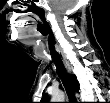 Infected Thyroglossal Duct Cyst Radiology Case Radiopaedia Org