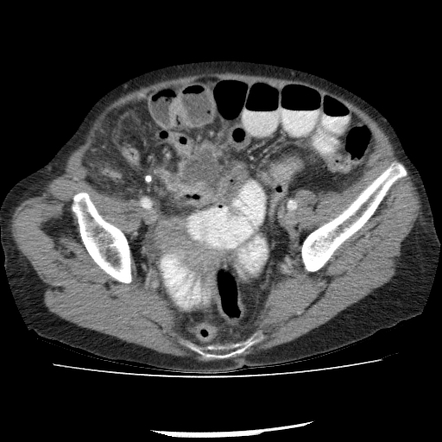 Perforated Appendix And Small Bowel Obstruction Radiology Case