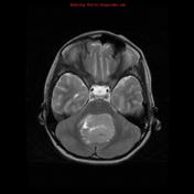 Viewing Playlist CNS Brain MRI Easy Radiopaedia Org