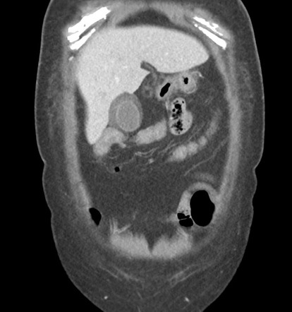 Acute Acalculous Cholecystitis Image Radiopaedia Org